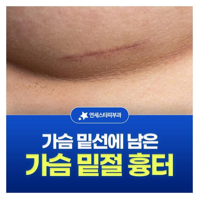 가슴 밑절 흉터, 가슴 밑선에 남은 흉터도 치료합니다