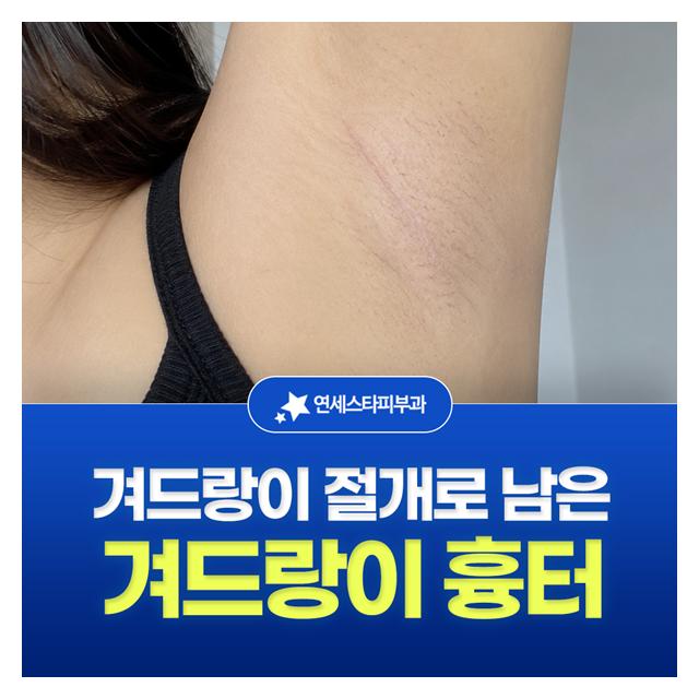 겨드랑이 흉터, 겨드랑이 절개로 남은 흉터도 치료합니다