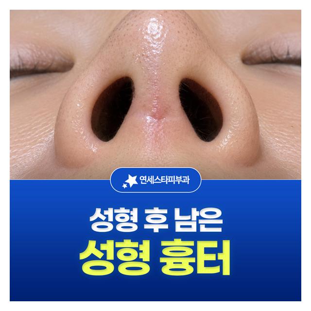 성형 흉터, 성형 후 남은 보이는 흉터도 빨리 제거하는게 좋습니다
